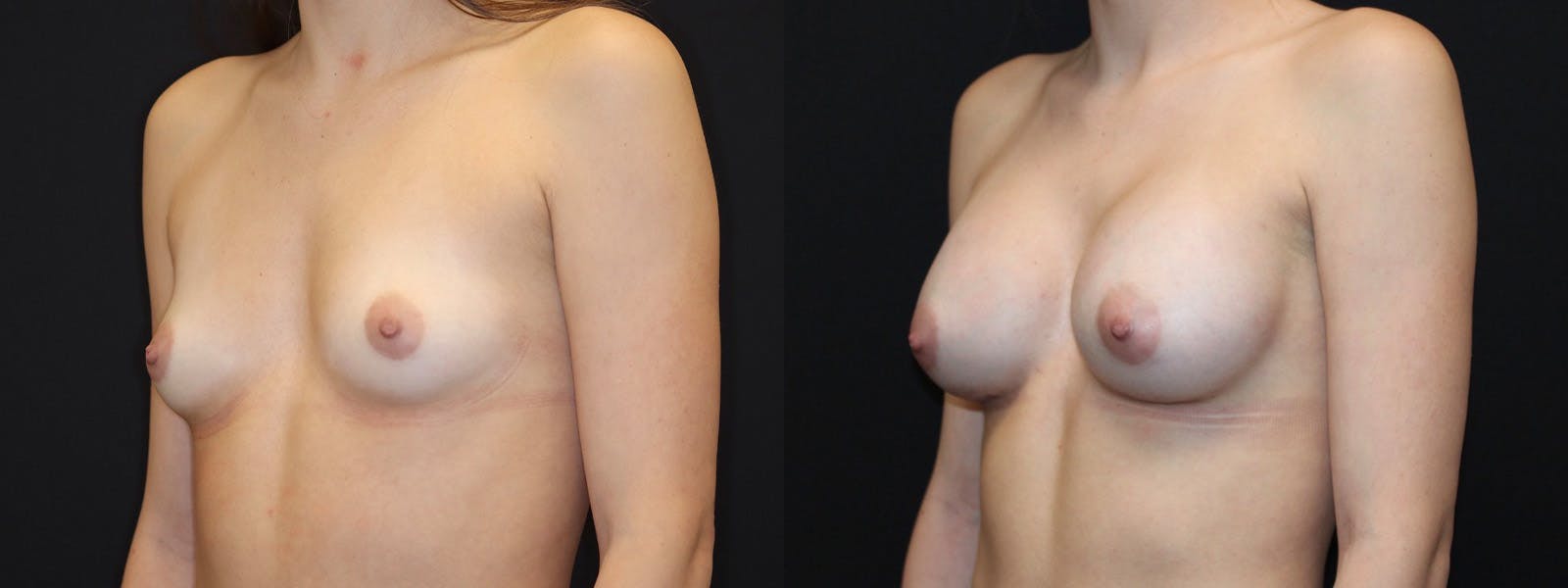 Breast Augmentation Before & After Gallery - Patient 541532 - Image 4