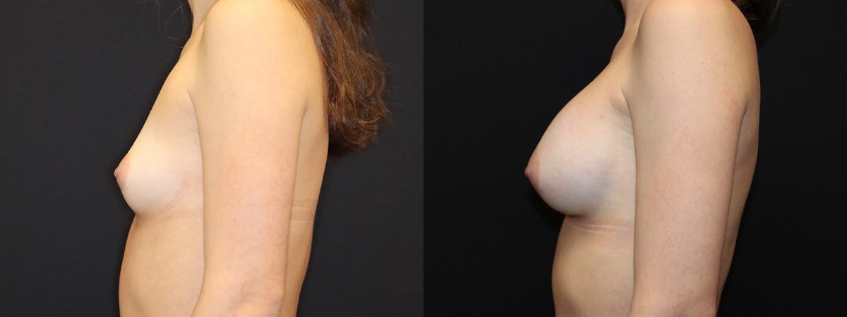 Breast Augmentation Before & After Gallery - Patient 541532 - Image 5