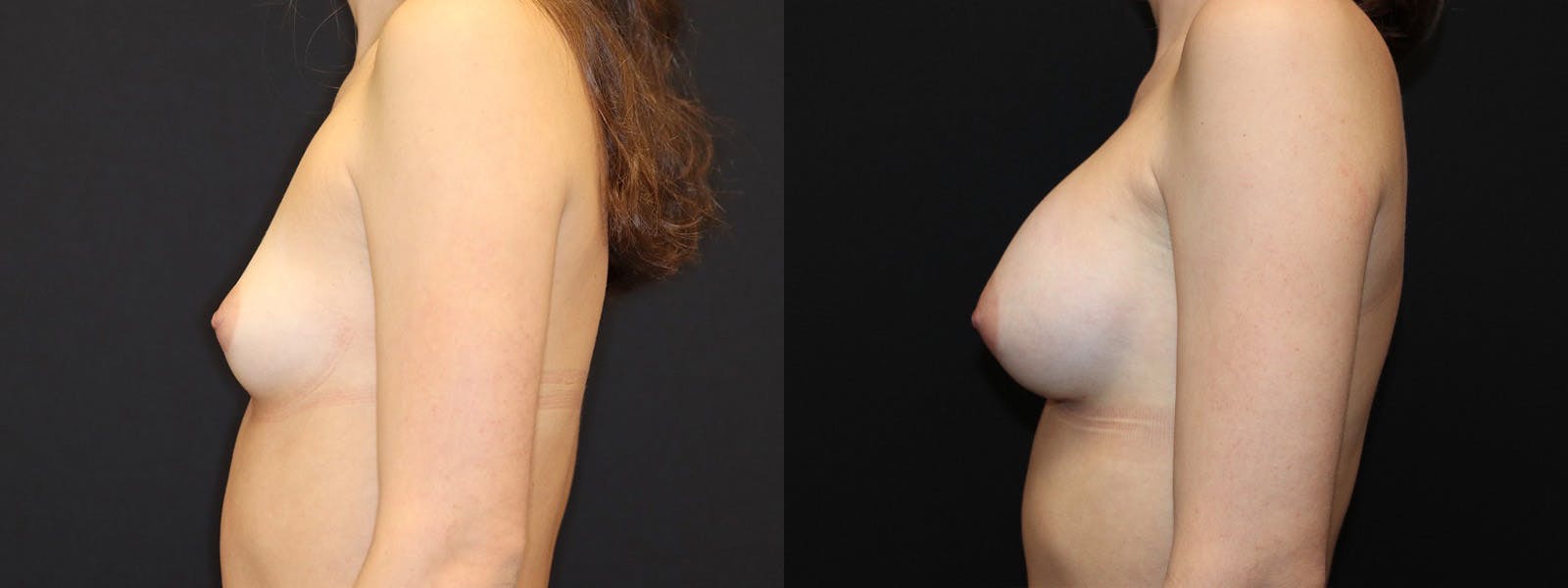 Breast Augmentation Before & After Gallery - Patient 541532 - Image 5