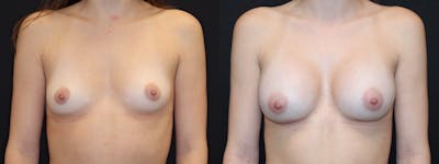 Breast Augmentation Before & After Gallery - Patient 541532 - Image 1
