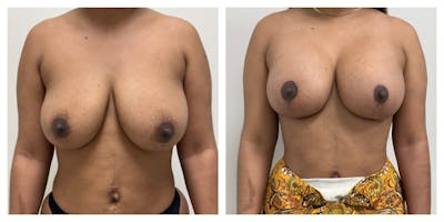Breast Augmentation + Lift Before & After Gallery - Patient 426653 - Image 1