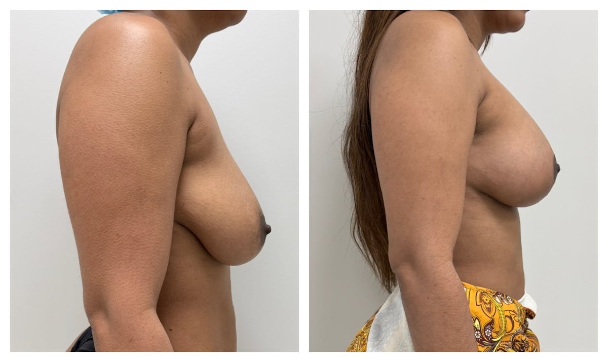 Breast Augmentation + Lift Before & After Gallery - Patient 426653 - Image 2