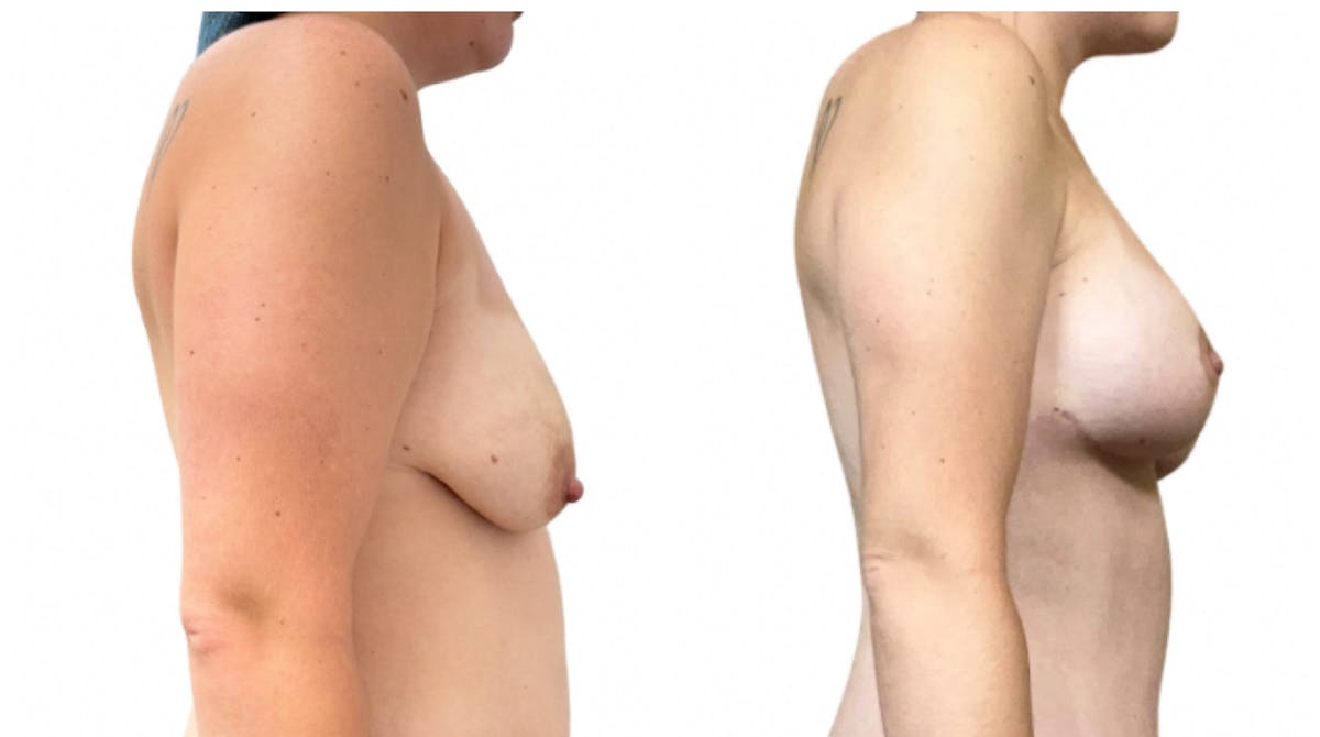 Breast Augmentation + Lift Before & After Gallery - Patient 195126 - Image 2