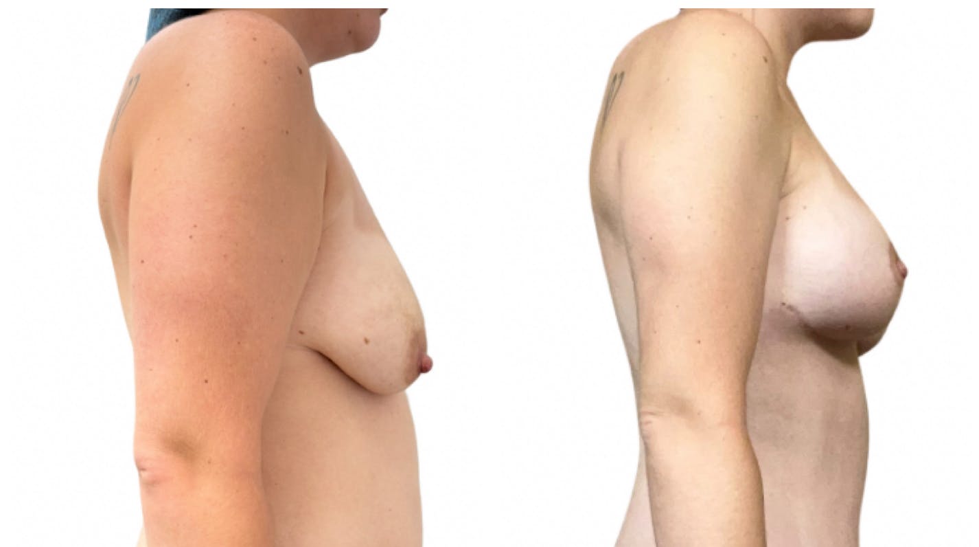 Breast Augmentation + Lift Before & After Gallery - Patient 195126 - Image 2