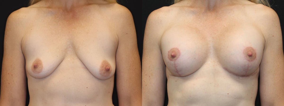 Breast Augmentation + Lift Before & After Gallery - Patient 314296 - Image 1