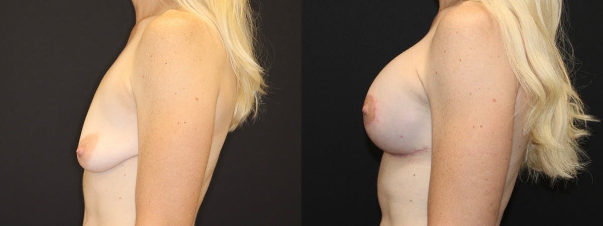 Breast Augmentation + Lift Before & After Gallery - Patient 314296 - Image 3