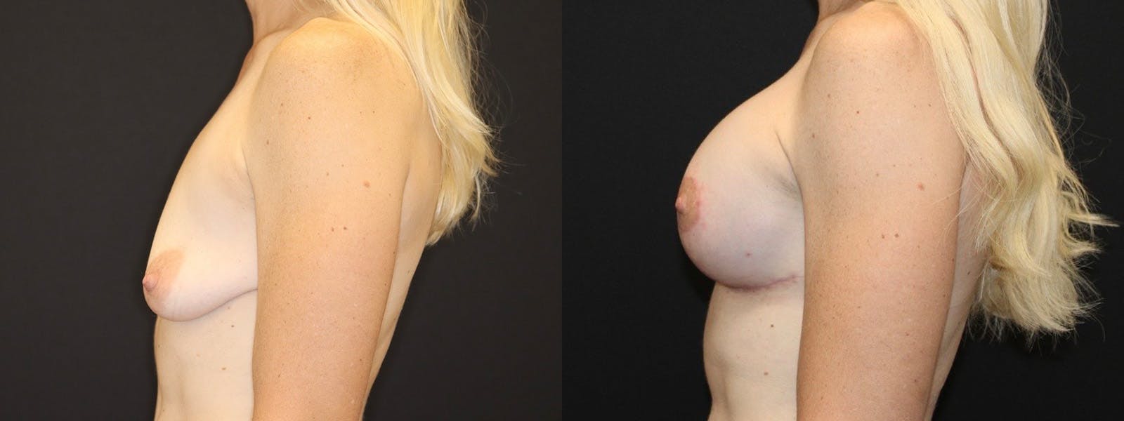 Breast Augmentation + Lift Before & After Gallery - Patient 314296 - Image 3