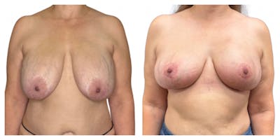 Breast Implant Explant Before & After Gallery - Patient 129564 - Image 1