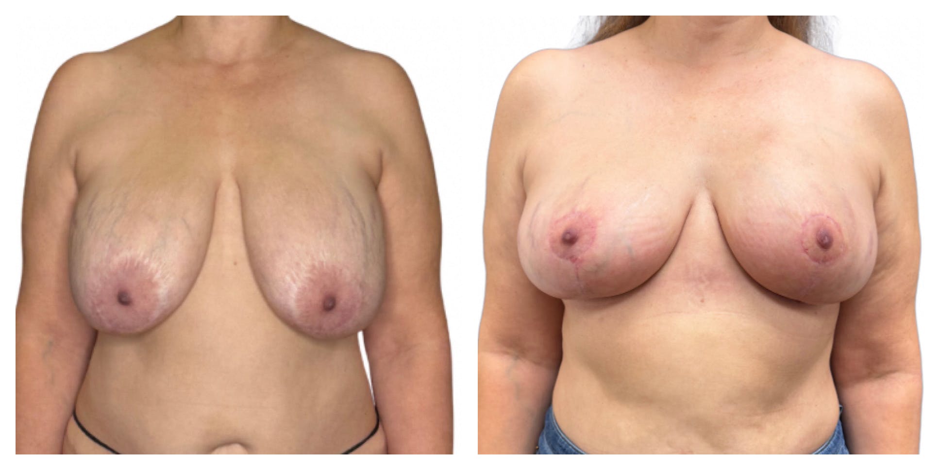 Breast Implant Explant Before & After Gallery - Patient 129564 - Image 1
