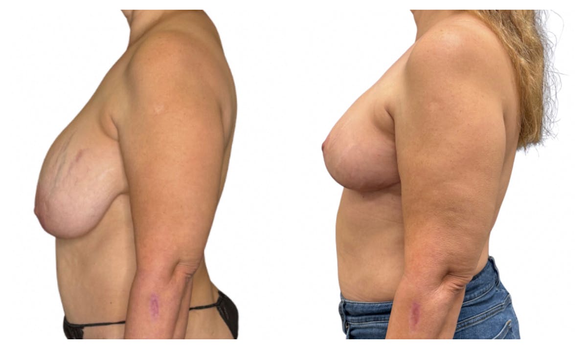 Breast Implant Explant Before & After Gallery - Patient 129564 - Image 5