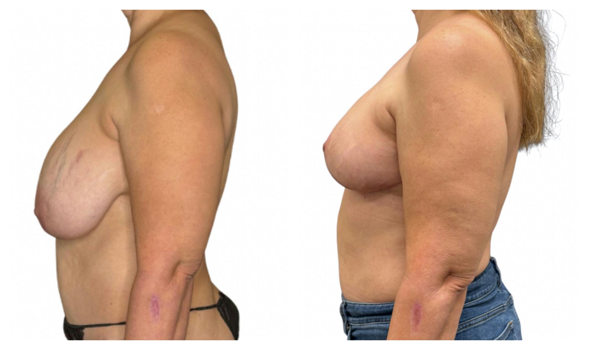 Breast Implant Explant Before & After Gallery - Patient 129564 - Image 5