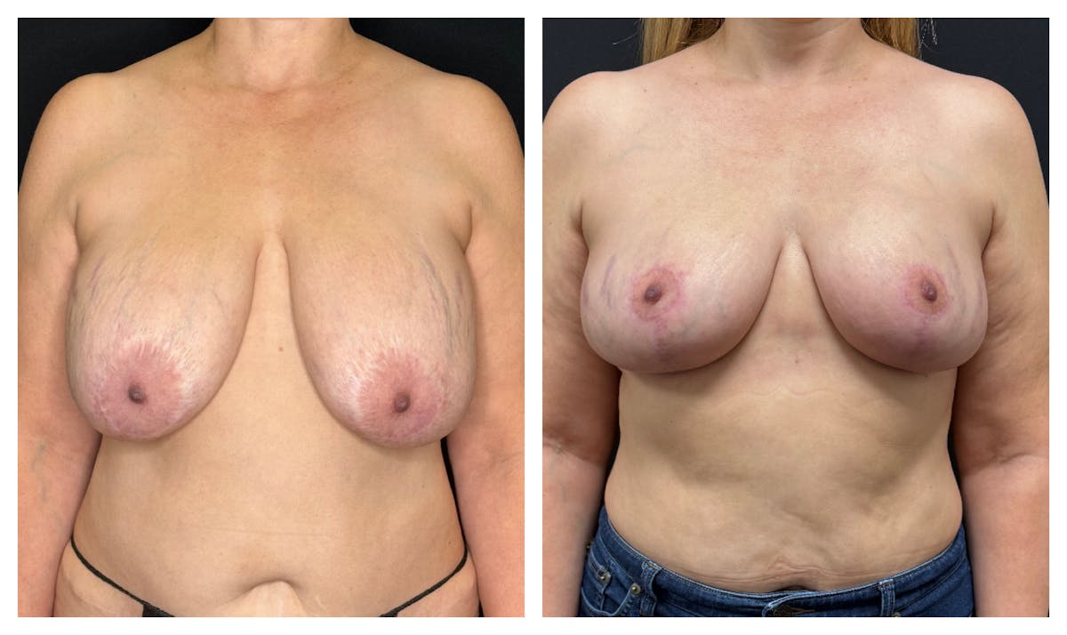 Breast Implant Explant Before & After Gallery - Patient 129564 - Image 2