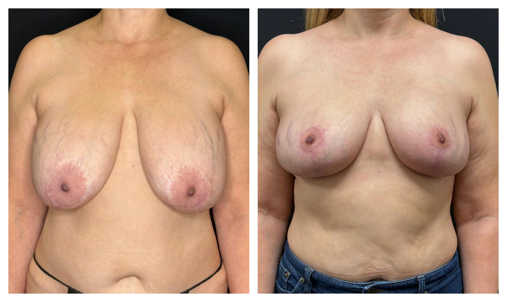 Breast Implant Explant Before & After Gallery - Patient 129564 - Image 2
