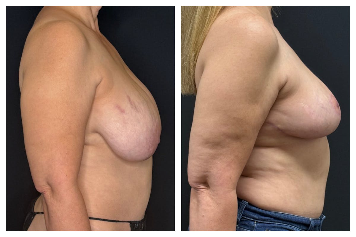 Breast Implant Explant Before & After Gallery - Patient 129564 - Image 3