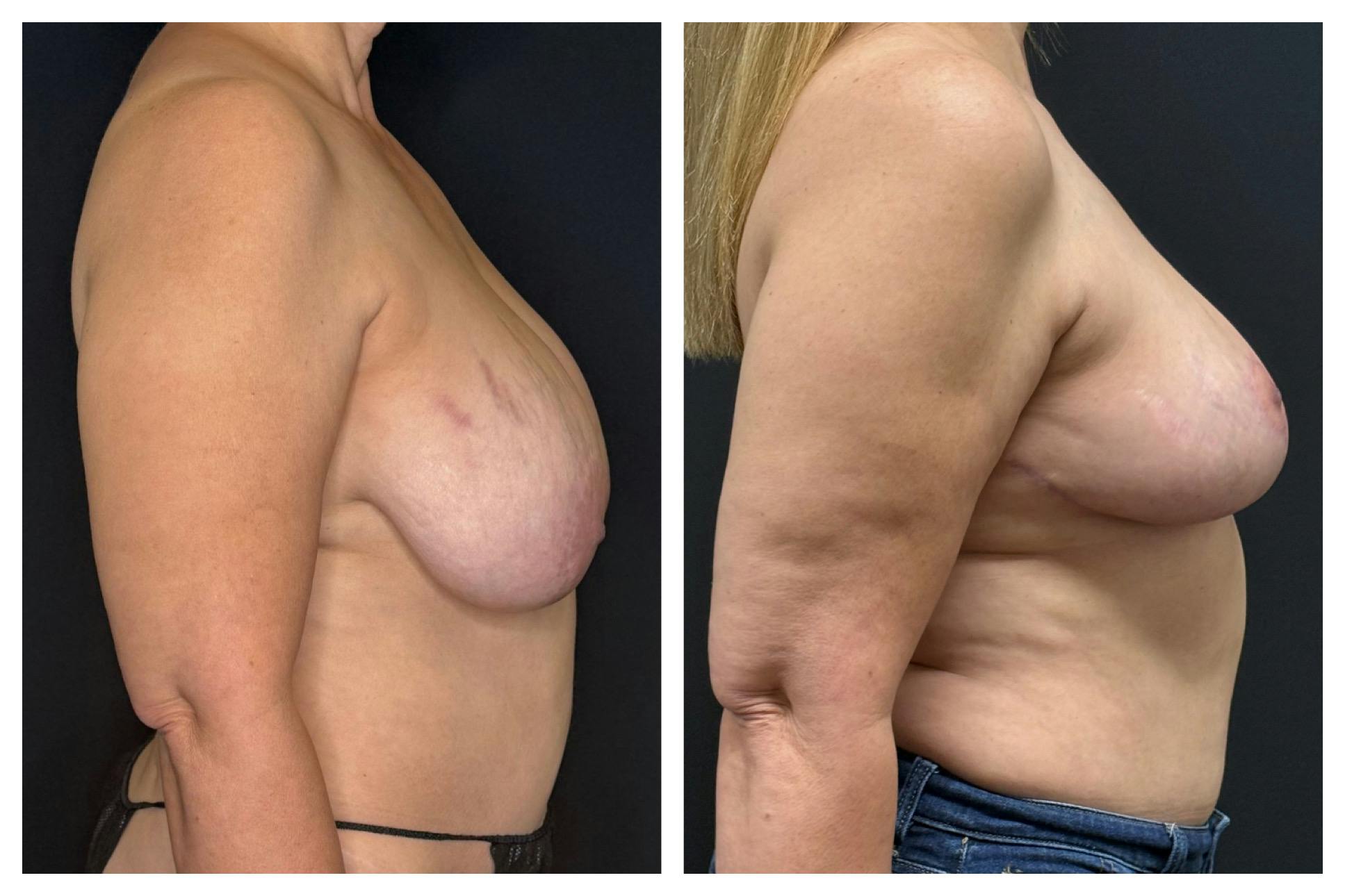 Breast Implant Explant Before & After Gallery - Patient 129564 - Image 3