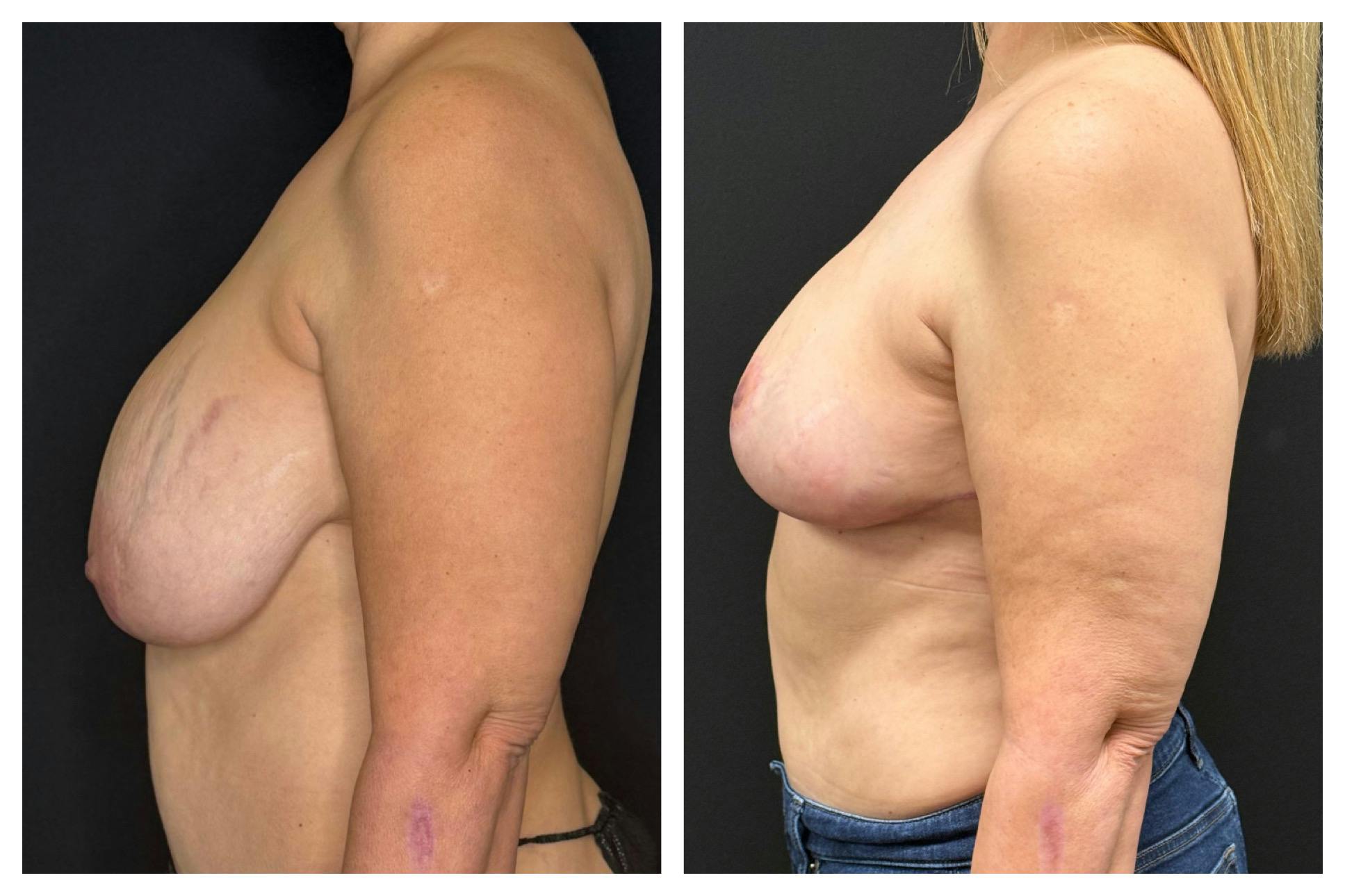 Breast Implant Explant Before & After Gallery - Patient 129564 - Image 4