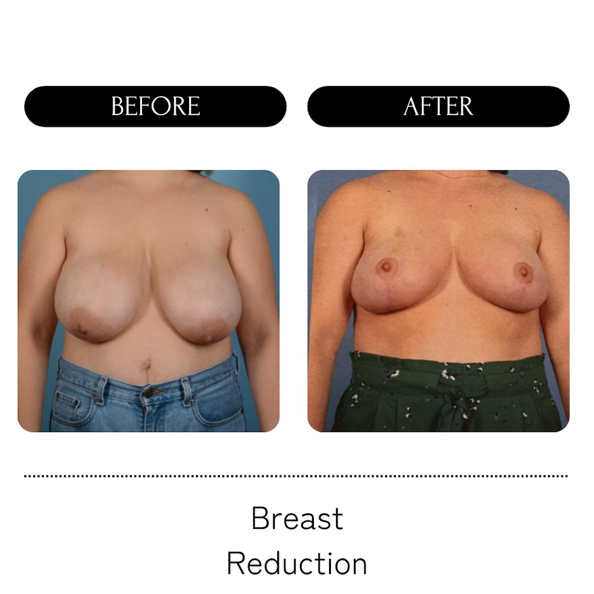 Breast Lift + Reduction Before & After Gallery - Patient 118556 - Image 1