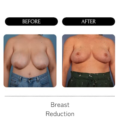 Breast Lift + Reduction Before & After Gallery - Patient 118556 - Image 1