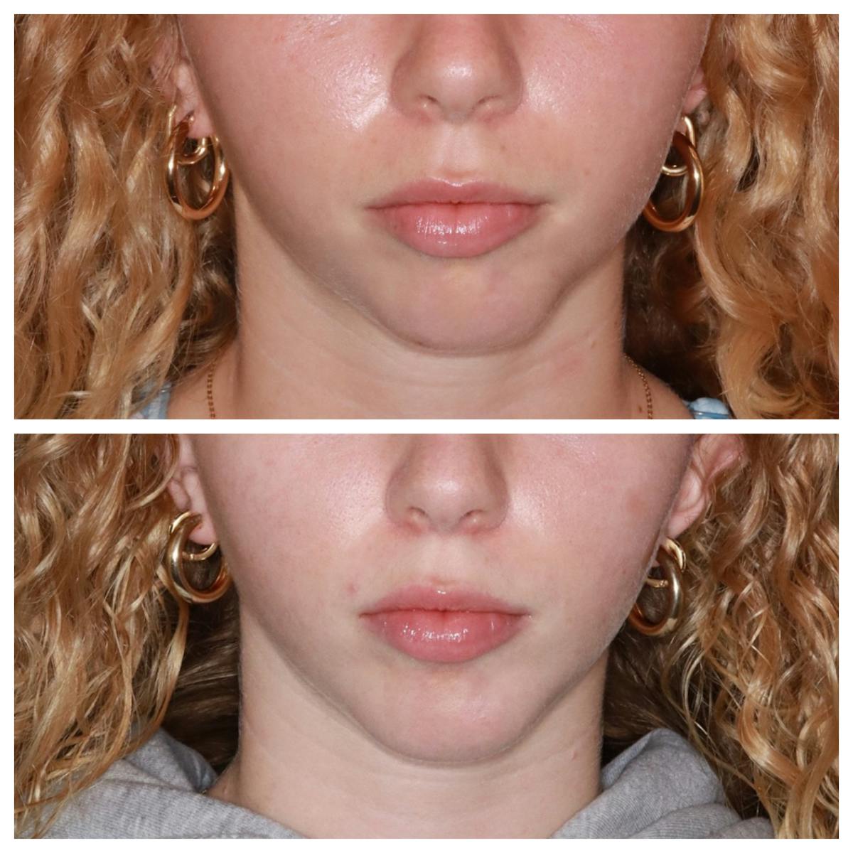 Chin Implant Before & After Gallery - Patient 228216 - Image 2