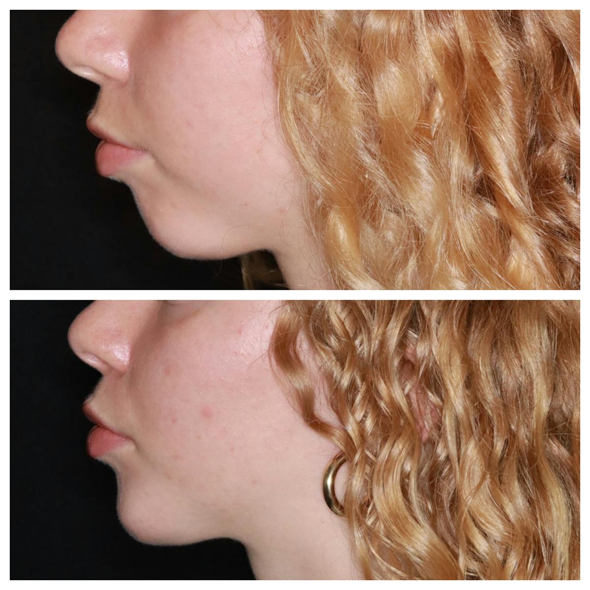 Chin Implant Before & After Gallery - Patient 228216 - Image 1