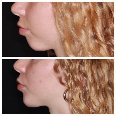 Chin Implant Before & After Gallery - Patient 228216 - Image 1