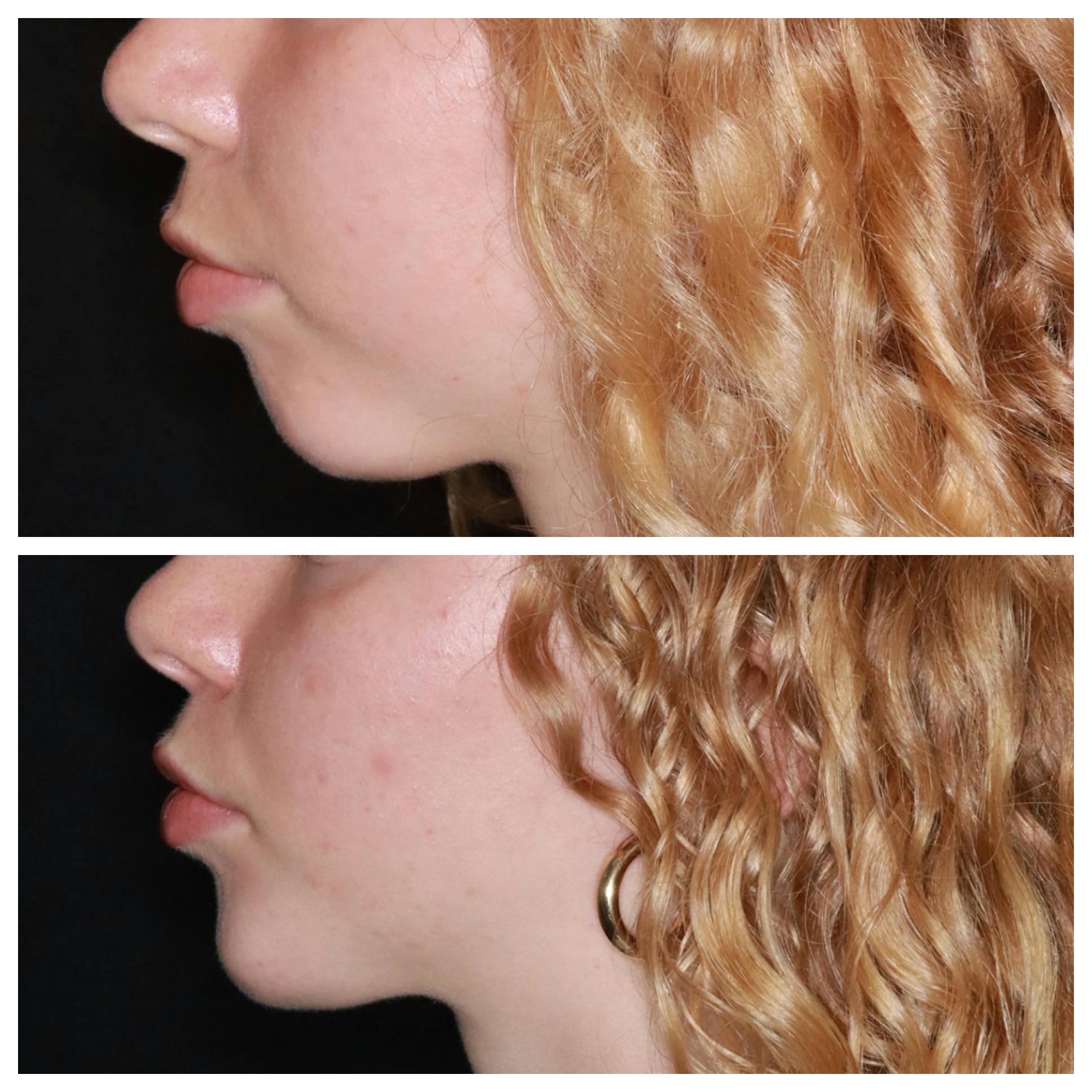 Chin Implant Before & After Gallery - Patient 228216 - Image 1