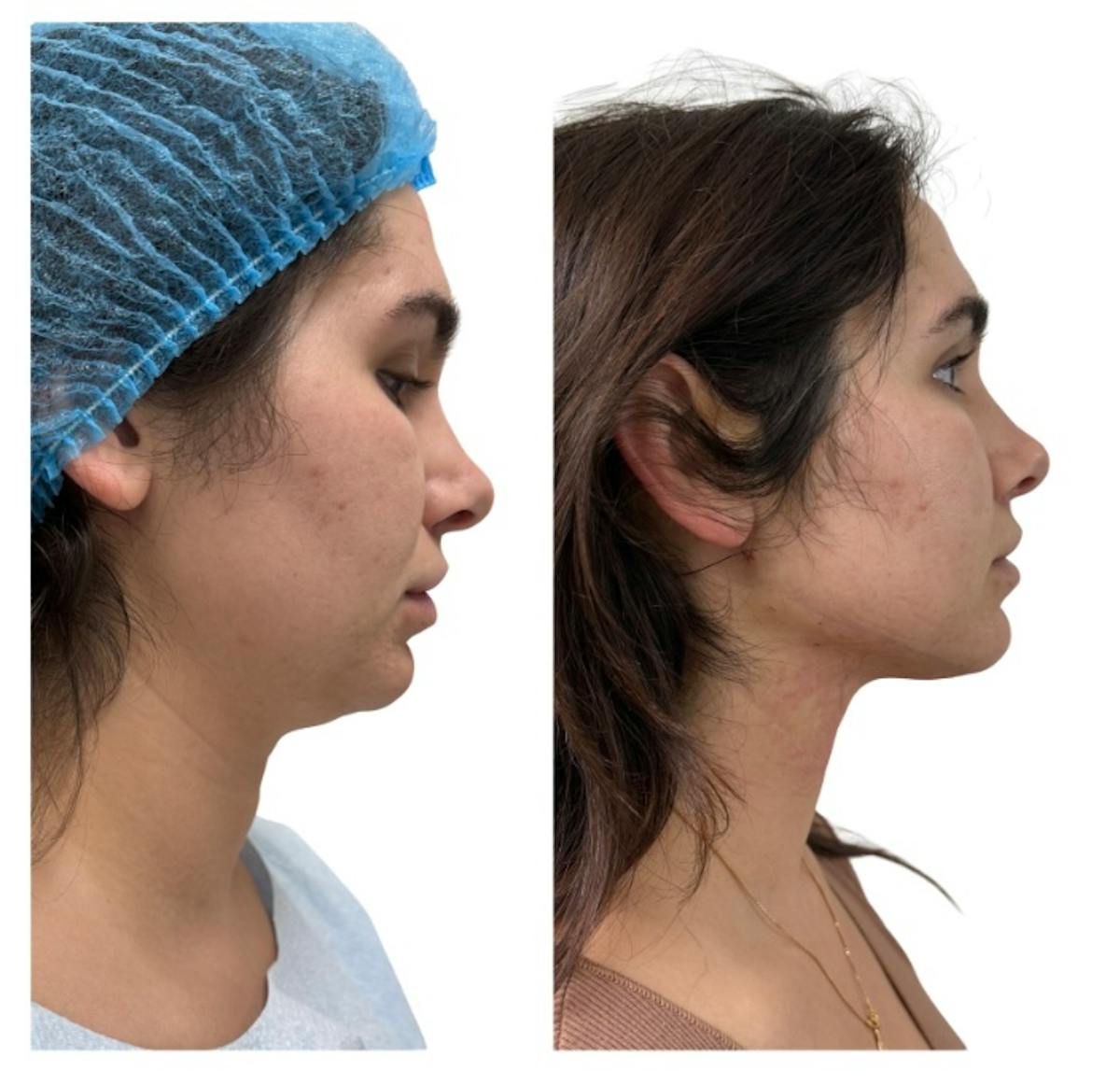 Chin Liposuction Before & After Gallery - Patient 389239 - Image 1