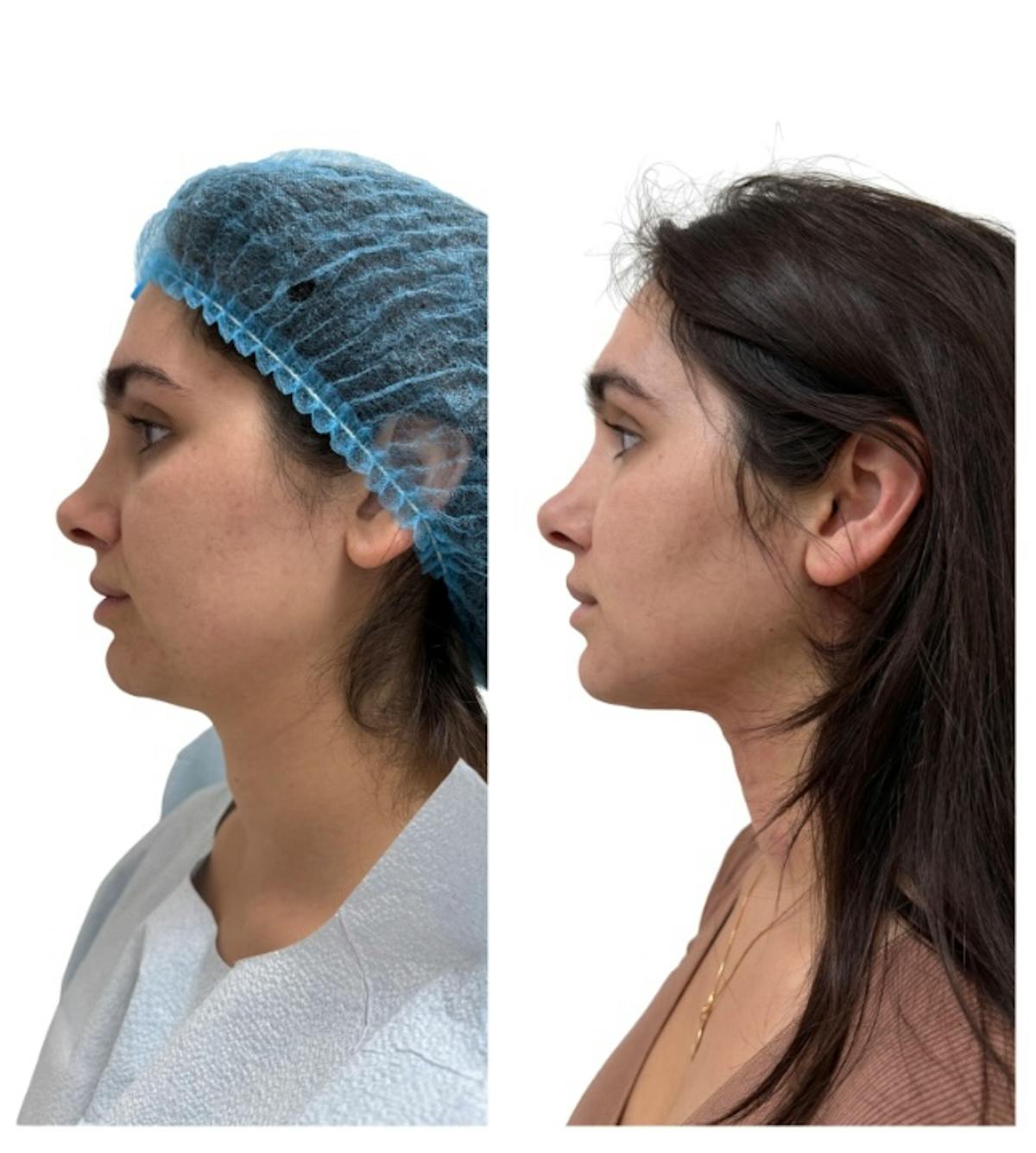 Chin Liposuction Before & After Gallery - Patient 389239 - Image 2