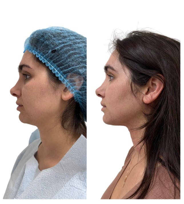 Chin Liposuction Before & After Gallery - Patient 389239 - Image 2