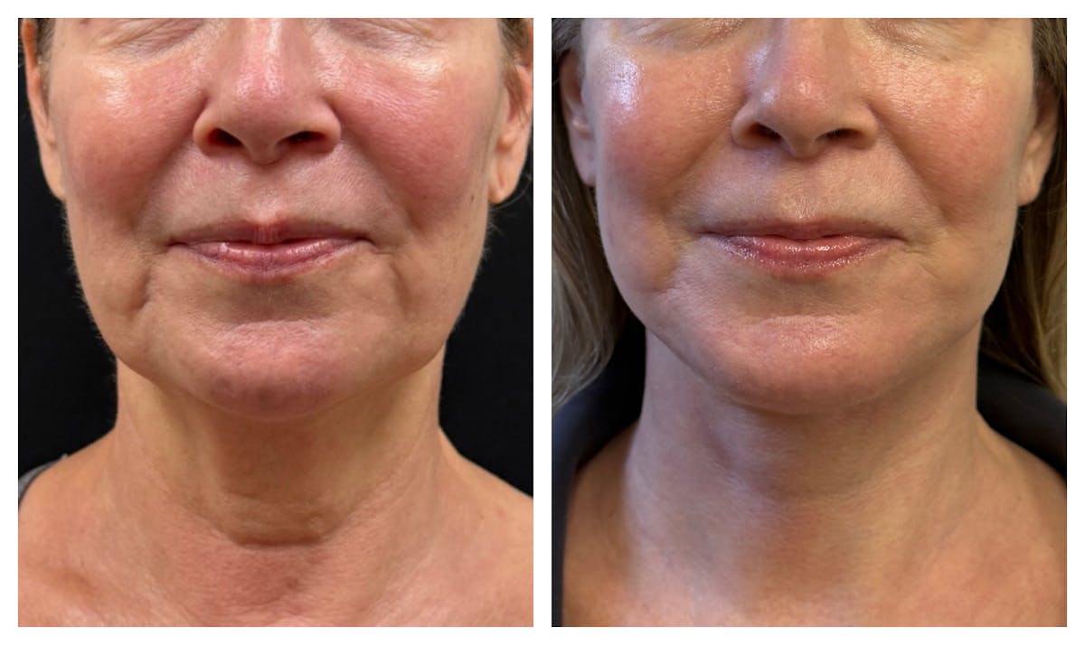 Face and Neck Lift Before & After Gallery - Patient 252159 - Image 1