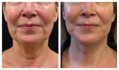 Face and Neck Lift Before & After Gallery - Patient 252159 - Image 1