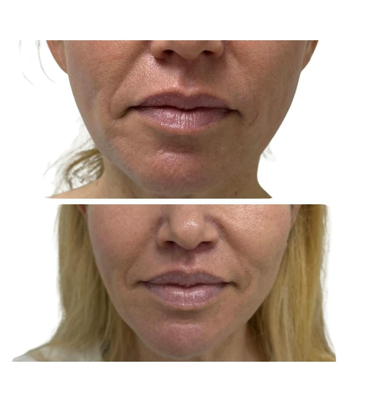 Lip Lift Before & After Gallery - Patient 347005 - Image 1