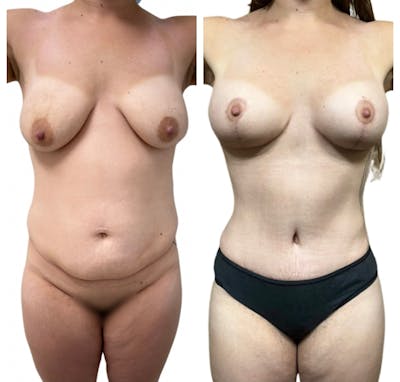 Mommy Makeover Before & After Gallery - Patient 326422 - Image 1