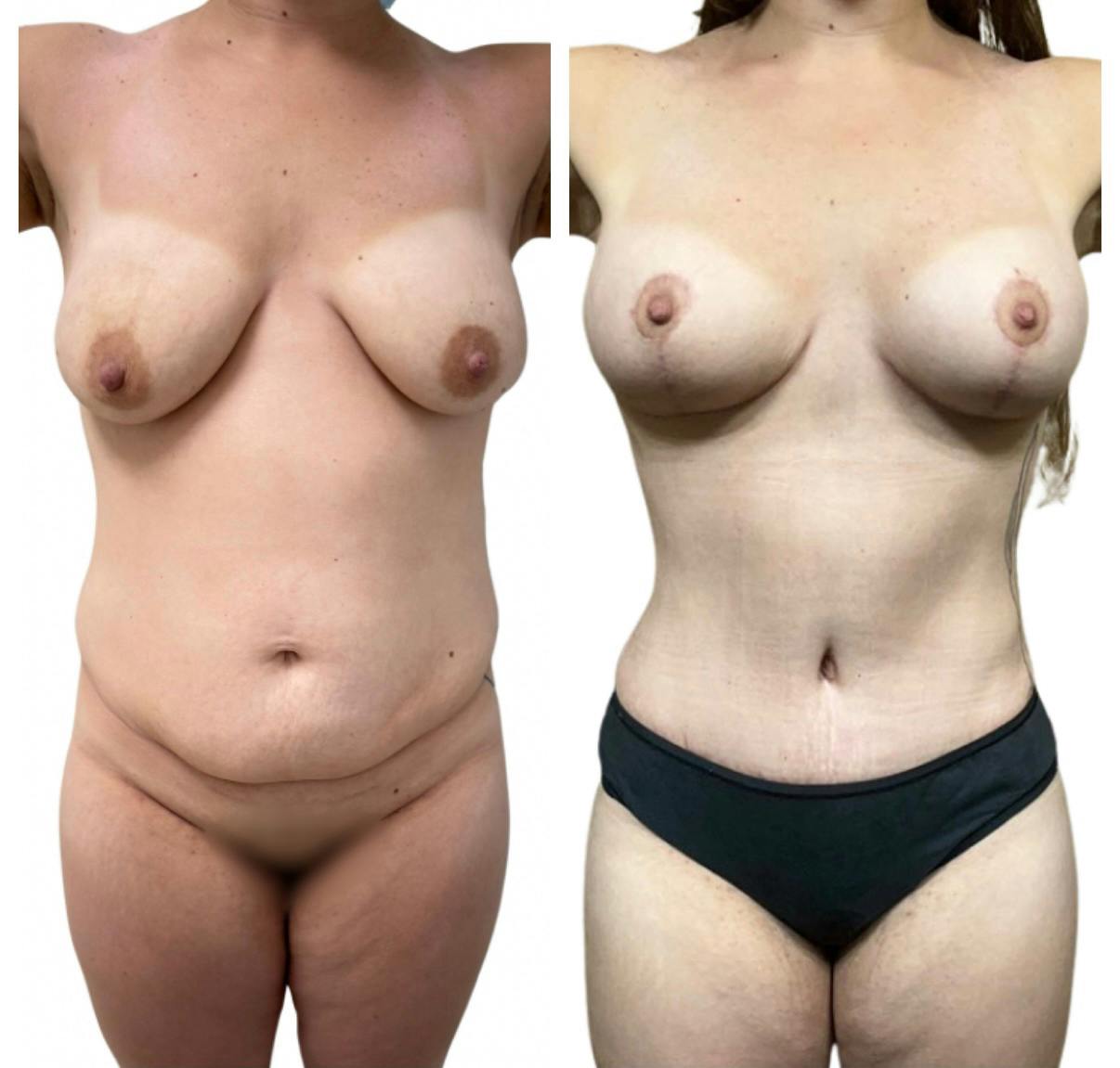 Mommy Makeover Before & After Gallery - Patient 326422 - Image 1