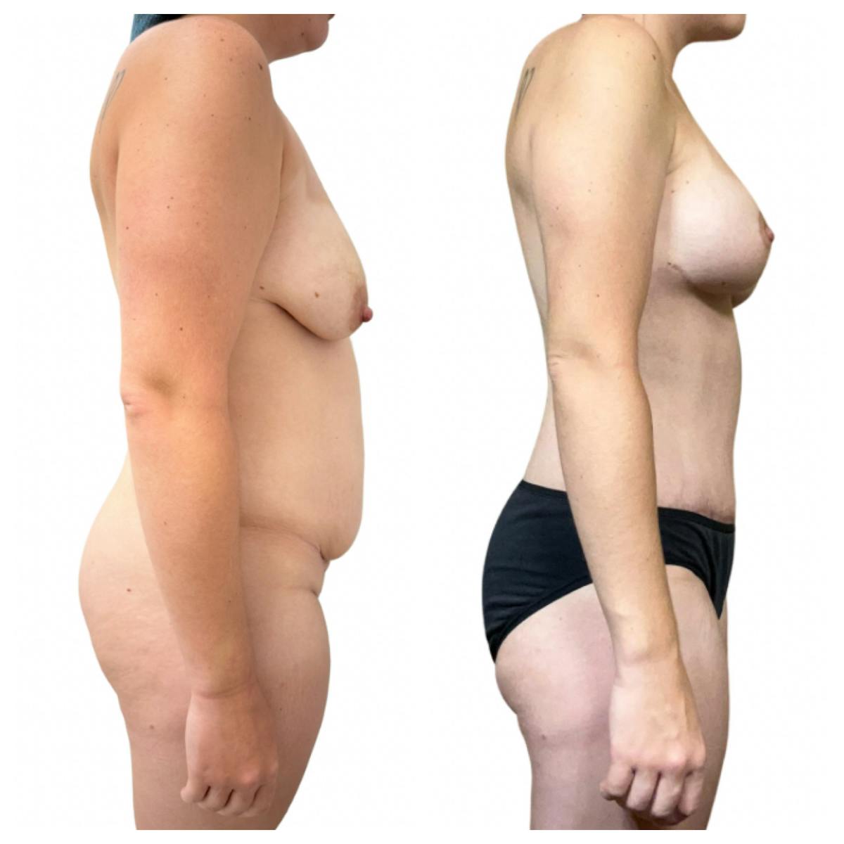 Mommy Makeover Before & After Gallery - Patient 326422 - Image 2