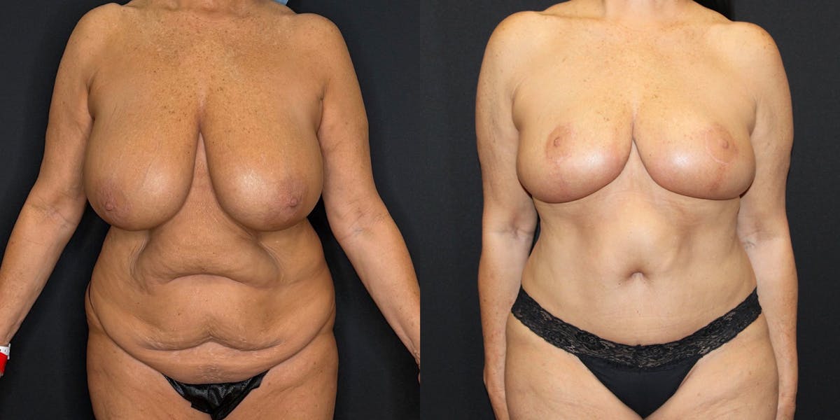 Mommy Makeover Before & After Gallery - Patient 263126 - Image 1