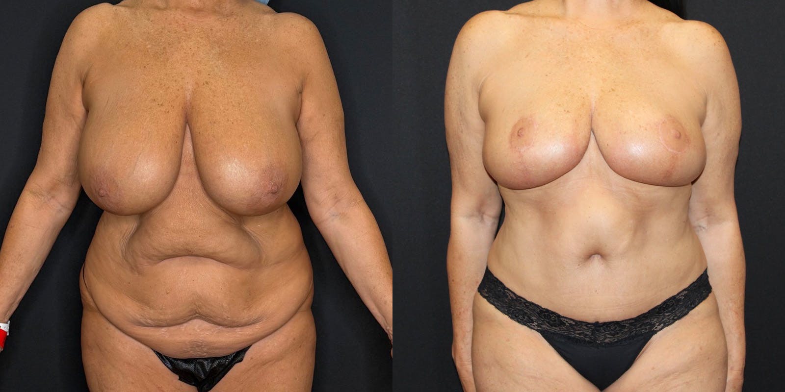 Mommy Makeover Before & After Gallery - Patient 263126 - Image 1