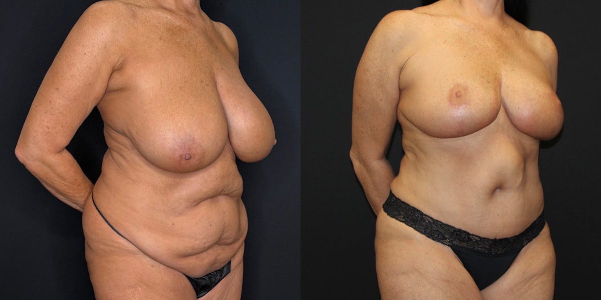 Mommy Makeover Before & After Gallery - Patient 263126 - Image 2