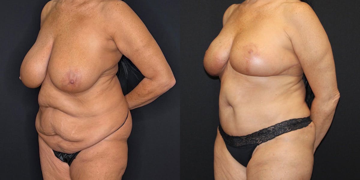 Mommy Makeover Before & After Gallery - Patient 263126 - Image 4