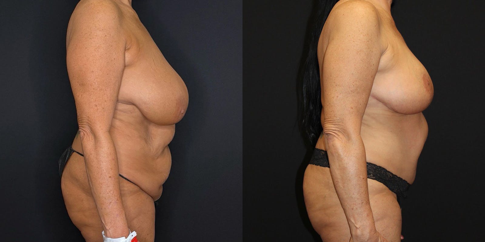 Mommy Makeover Before & After Gallery - Patient 263126 - Image 3