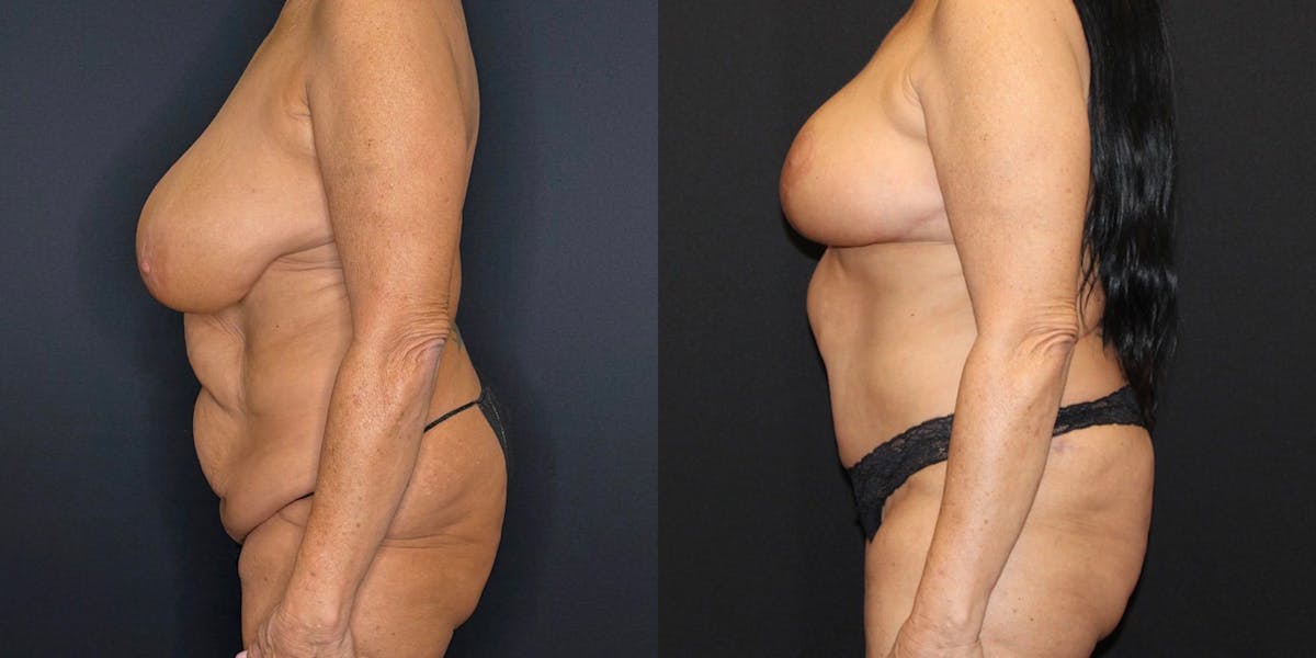 Mommy Makeover Before & After Gallery - Patient 263126 - Image 5