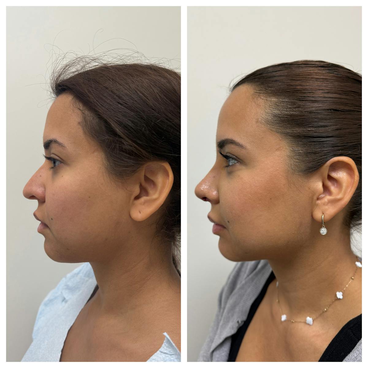 Rhinoplasty Before & After Gallery - Patient 146441 - Image 3