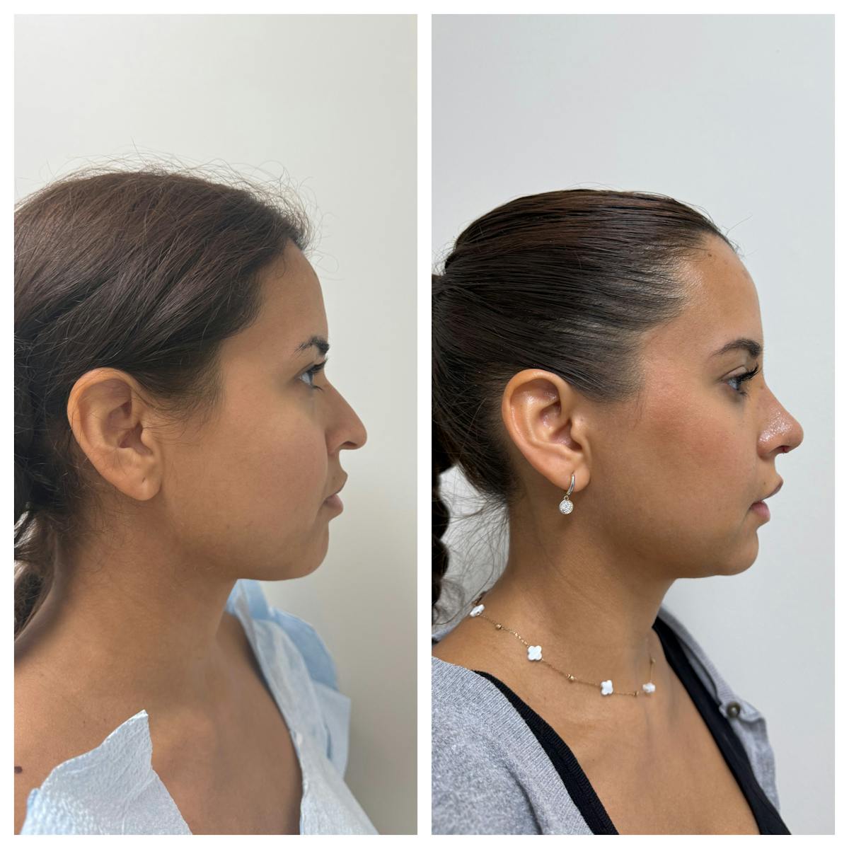 Rhinoplasty Before & After Gallery - Patient 146441 - Image 2
