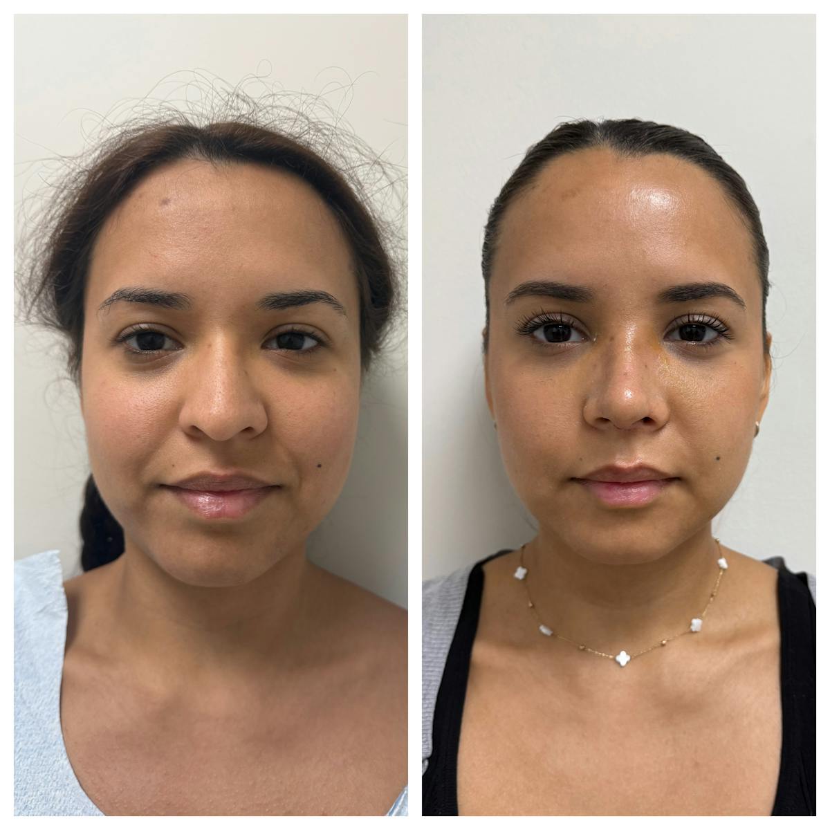 Rhinoplasty Before & After Gallery - Patient 146441 - Image 1