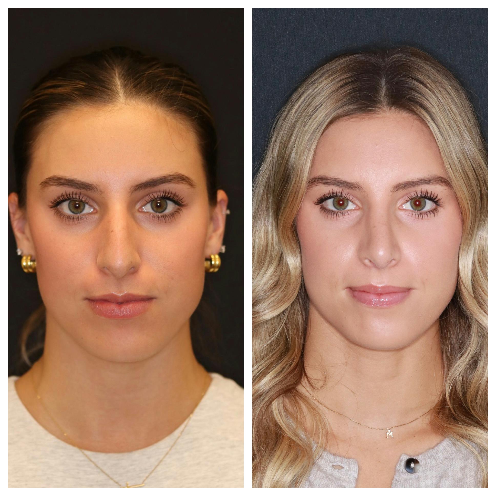 Rhinoplasty Before & After Gallery - Patient 421133 - Image 1