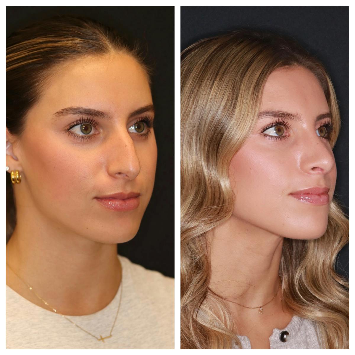 Rhinoplasty Before & After Gallery - Patient 421133 - Image 2
