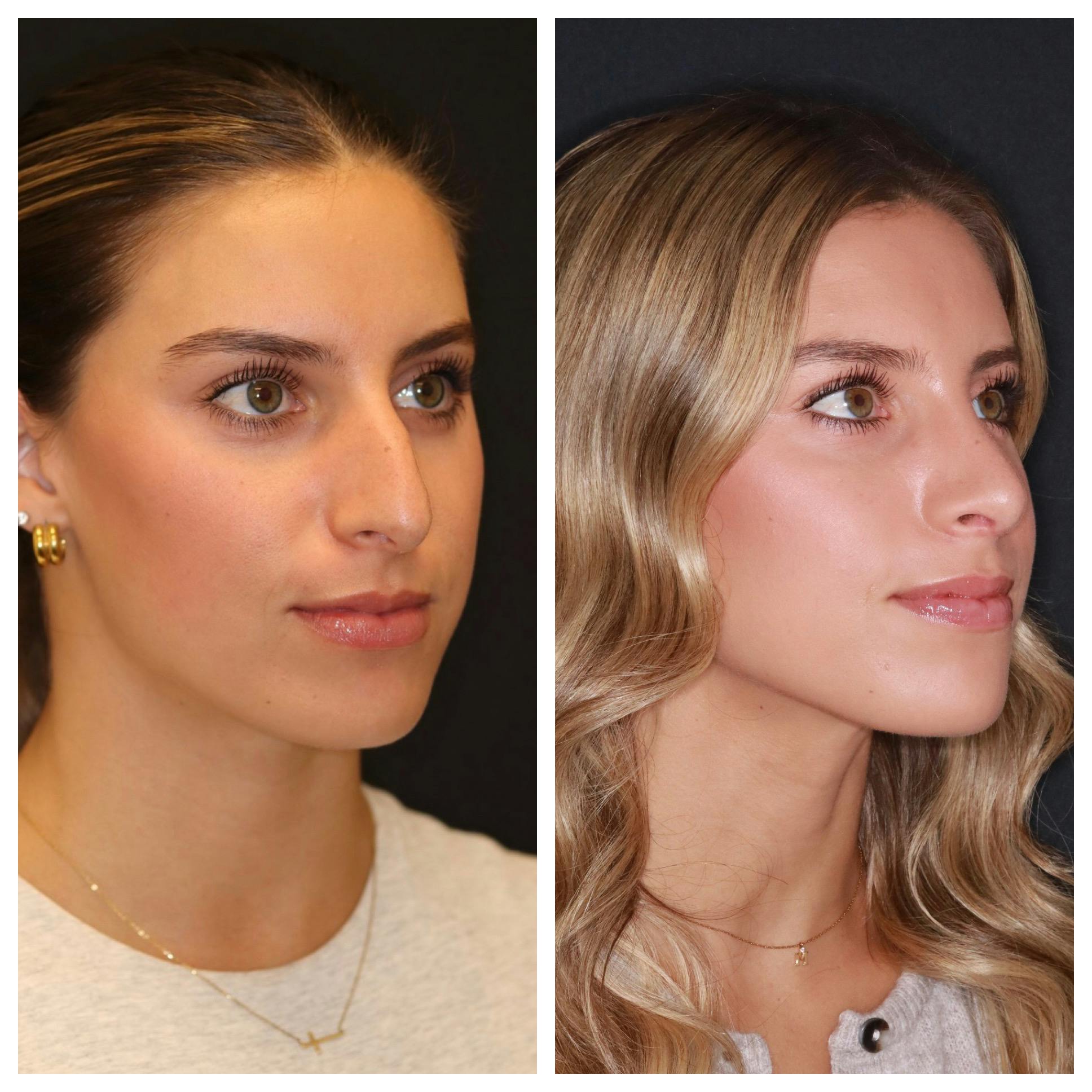Rhinoplasty Before & After Gallery - Patient 421133 - Image 2
