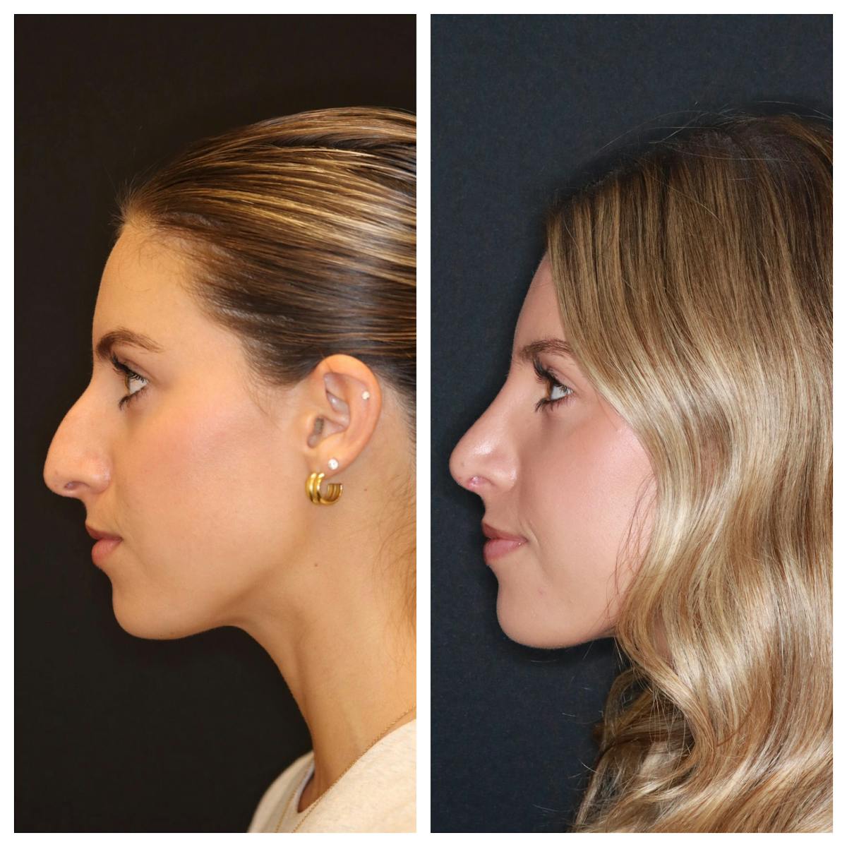 Rhinoplasty Before & After Gallery - Patient 421133 - Image 5