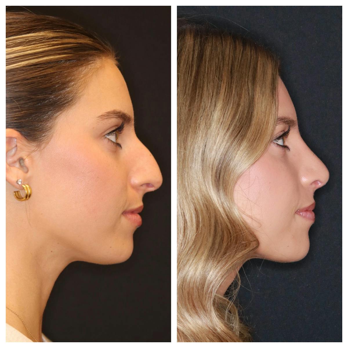 Rhinoplasty Before & After Gallery - Patient 421133 - Image 3
