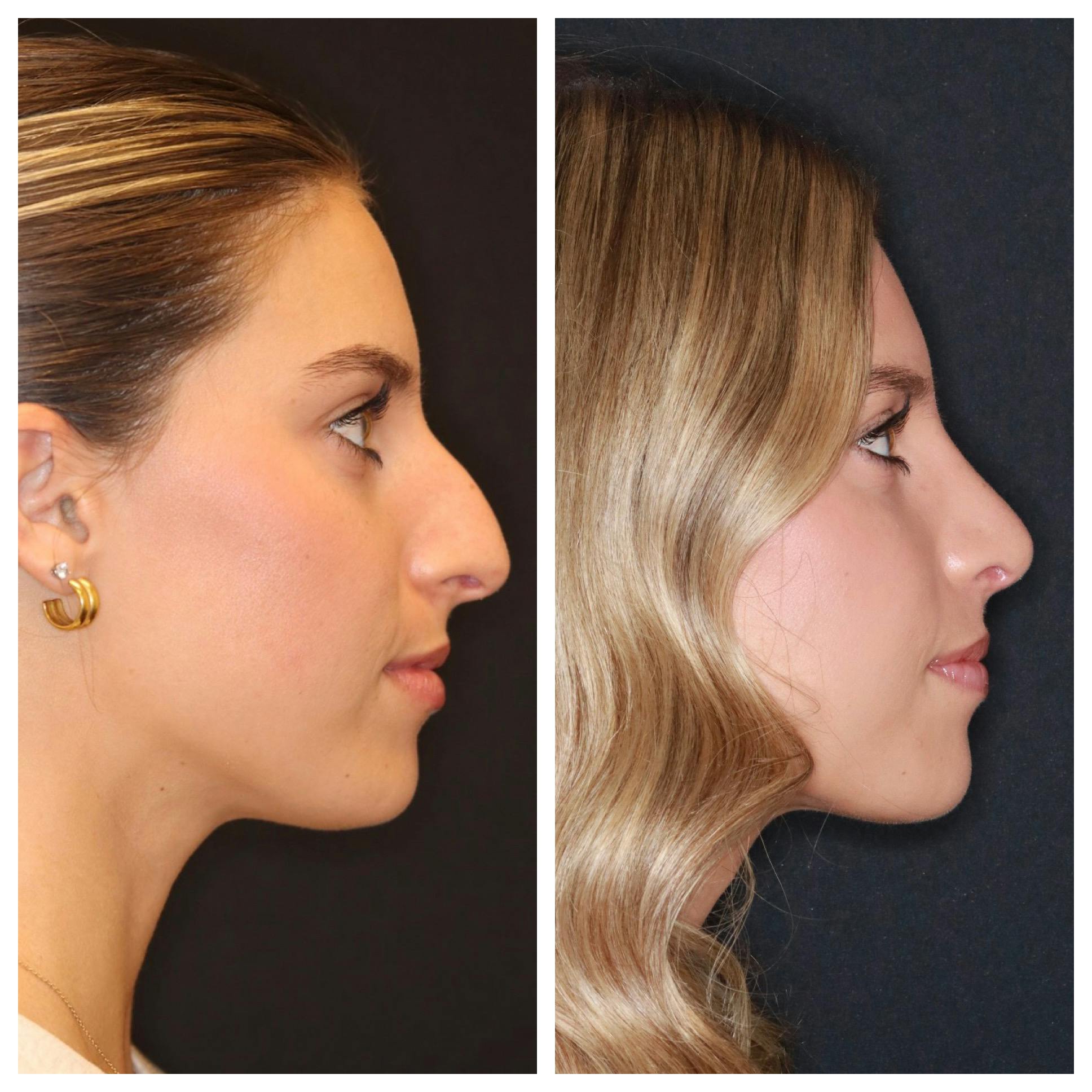 Rhinoplasty Before & After Gallery - Patient 421133 - Image 3